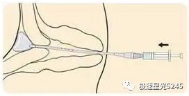 子宫球囊支架怎么取很多临床在使用球囊子宫支架都会存在操作误区，竹海生物一次性使用三角球囊支架正确操作解读_https://www.jmylbn.com_新闻资讯_第6张