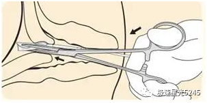子宫球囊支架怎么取很多临床在使用球囊子宫支架都会存在操作误区，竹海生物一次性使用三角球囊支架正确操作解读_https://www.jmylbn.com_新闻资讯_第3张