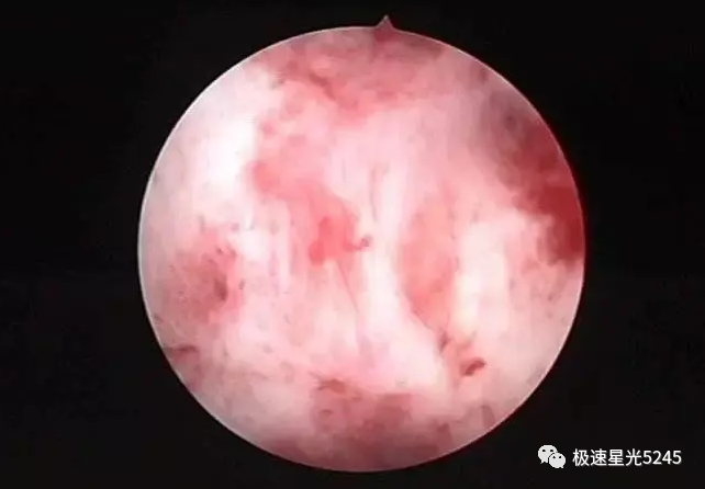 子宫球囊支架怎么取月经周期正常，经量却变少了？千万不要掉以轻心，竹海生物一次性球囊子宫支架提醒当心是宫腔粘连！_https://www.jmylbn.com_新闻资讯_第1张