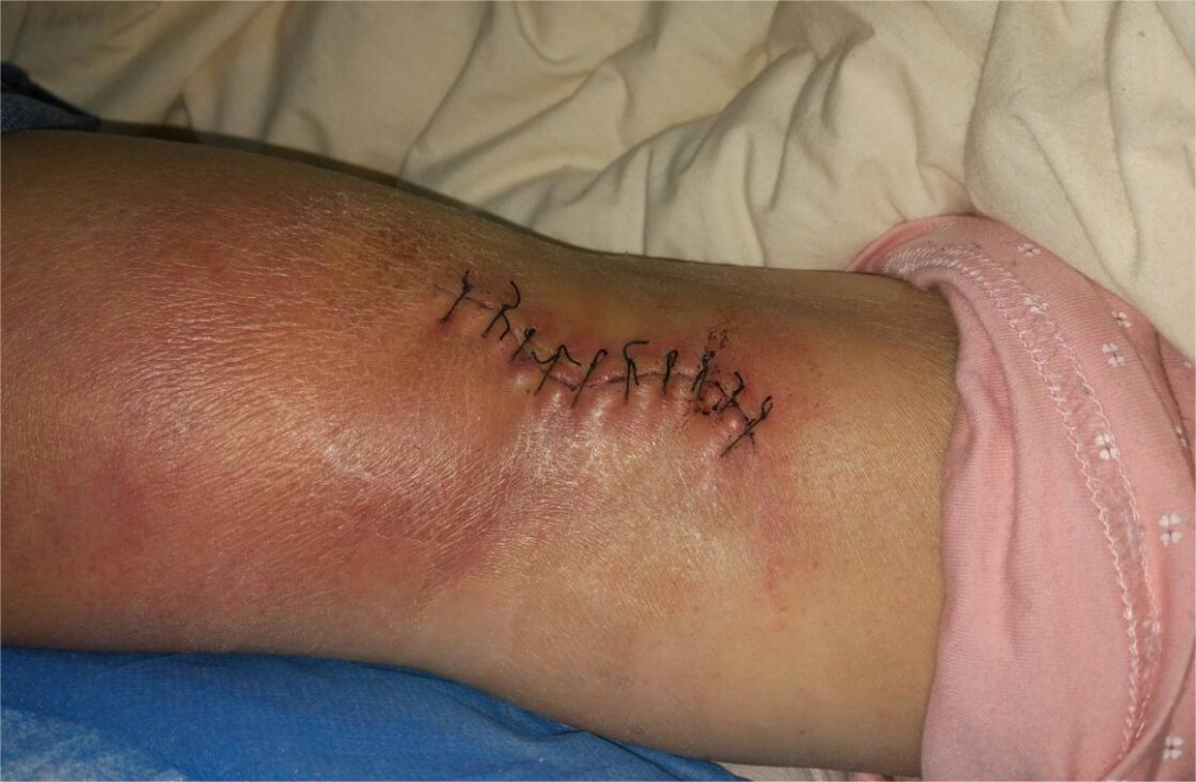 人工敷料怎么照顾伤口【健康科普】伤口的自我管理和换药_https://www.jmylbn.com_新闻资讯_第8张