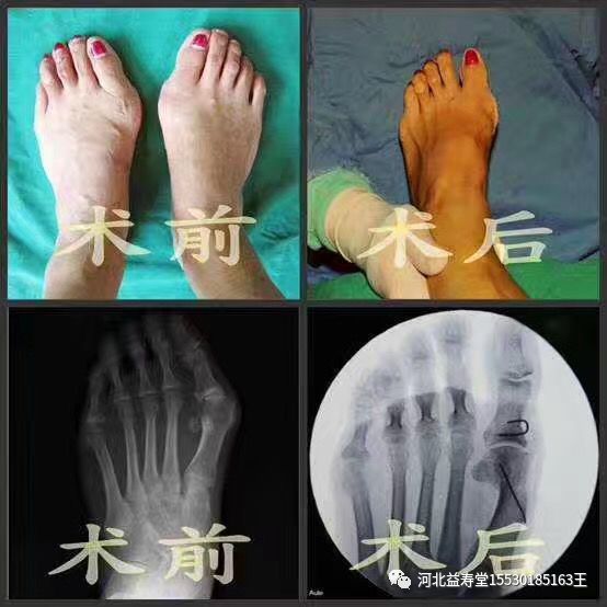 医用磨钻什么牌子好微创拇外翻专用设备-医用电动磨钻_https://www.jmylbn.com_新闻资讯_第29张