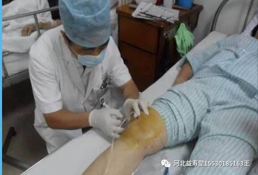 冲洗针怎么用视频膝关节冲洗（灌洗）的具体方法（收藏）_https://www.jmylbn.com_新闻资讯_第5张