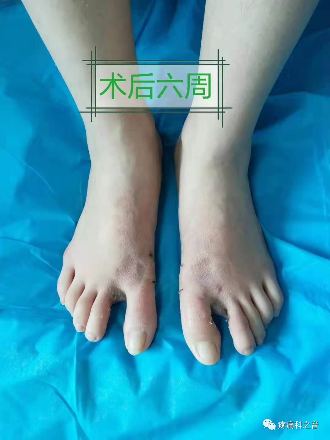 医用磨钻什么牌子好微创拇外翻专用设备-医用电动磨钻_https://www.jmylbn.com_新闻资讯_第19张