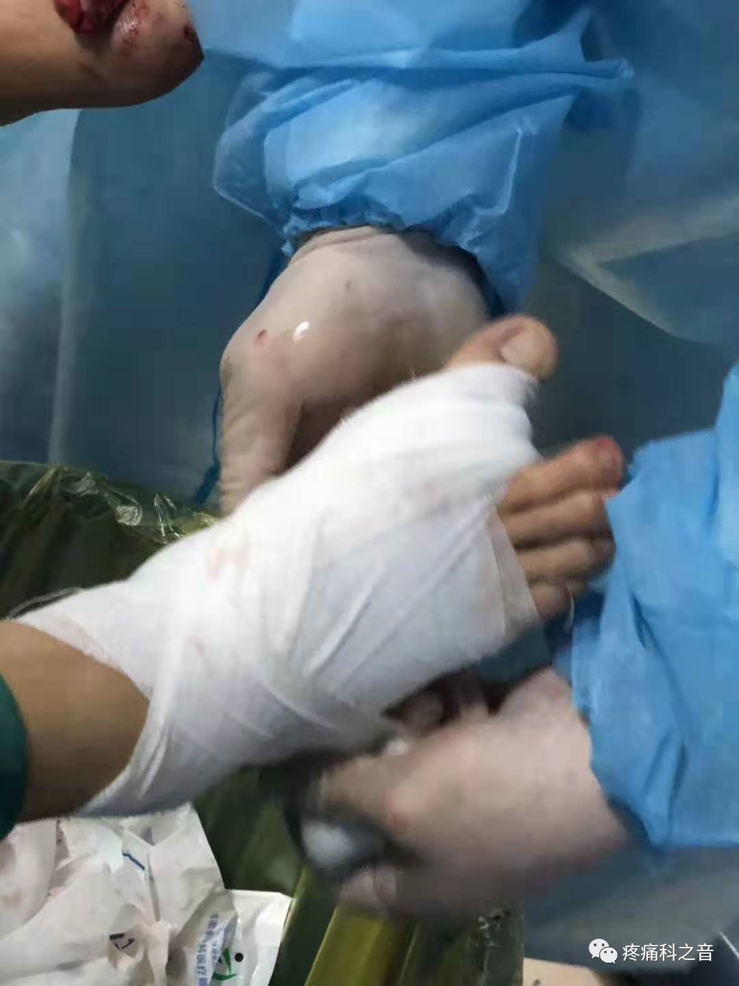 医用磨钻什么牌子好微创拇外翻专用设备-医用电动磨钻_https://www.jmylbn.com_新闻资讯_第25张