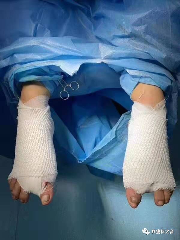 医用磨钻什么牌子好微创拇外翻专用设备-医用电动磨钻_https://www.jmylbn.com_新闻资讯_第26张