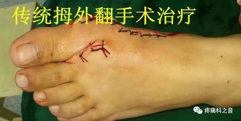 医用磨钻什么牌子好微创拇外翻专用设备-医用电动磨钻_https://www.jmylbn.com_新闻资讯_第20张