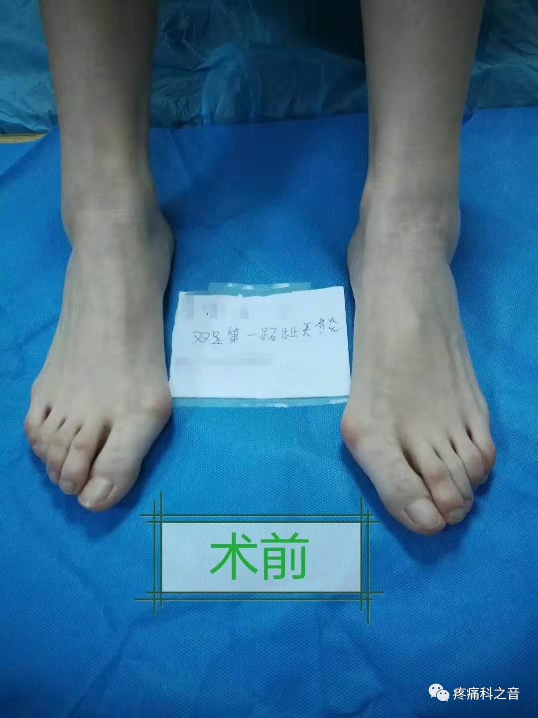 医用磨钻什么牌子好微创拇外翻专用设备-医用电动磨钻_https://www.jmylbn.com_新闻资讯_第18张