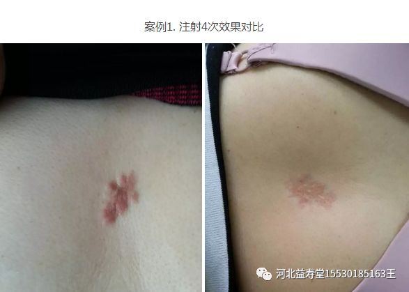 枪针怎么用医用麻醉枪拆卸安装保养维护使用大全【收藏】_https://www.jmylbn.com_新闻资讯_第6张