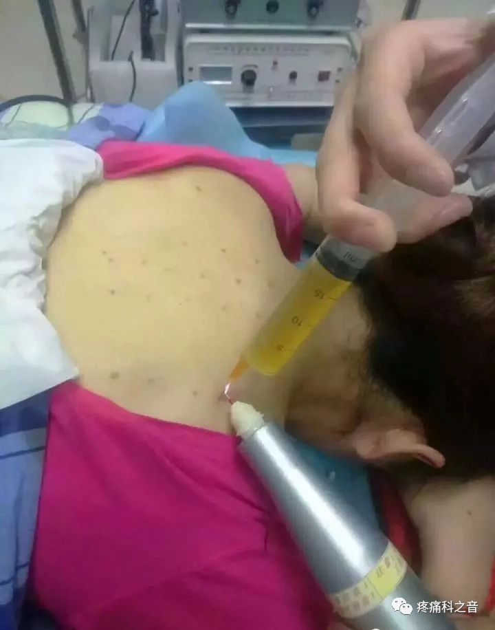 高频治疗仪治什么病离子束疼痛治疗仪（电火花疗法）_https://www.jmylbn.com_新闻资讯_第3张