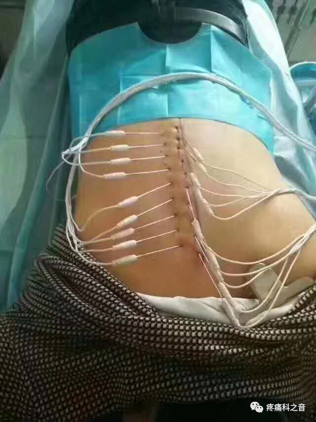 枪针怎么用医用麻醉枪拆卸安装保养维护使用大全【收藏】_https://www.jmylbn.com_新闻资讯_第13张