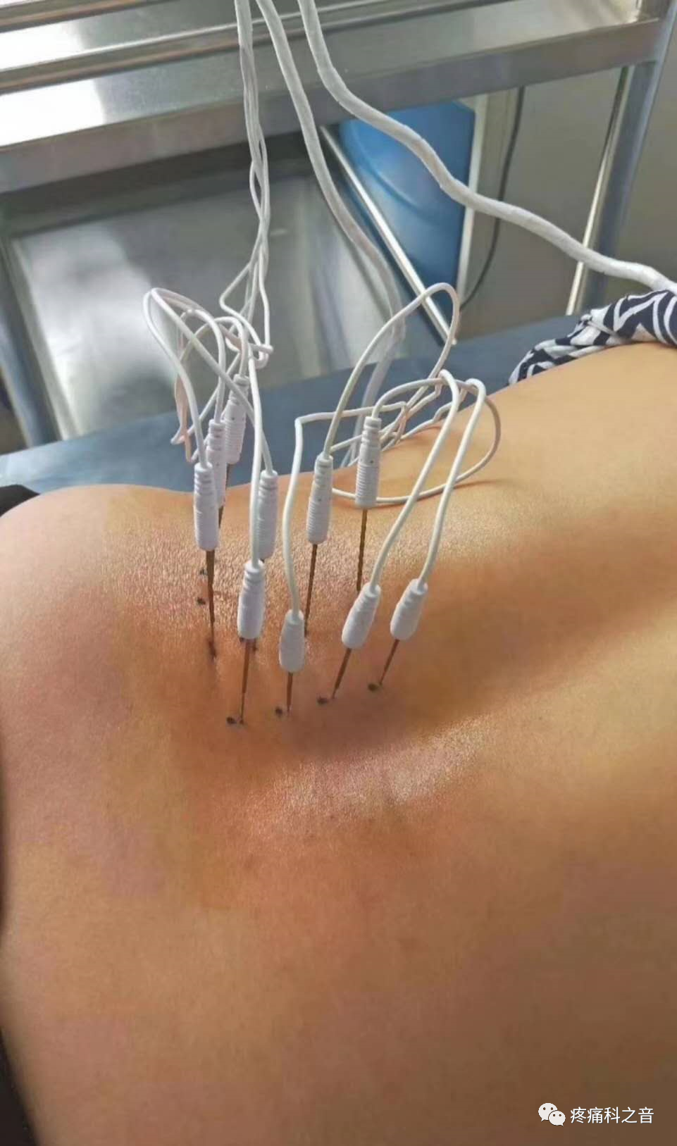 枪针怎么用医用麻醉枪拆卸安装保养维护使用大全【收藏】_https://www.jmylbn.com_新闻资讯_第14张