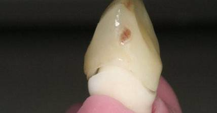 戴牙不就位，支点怎么找？