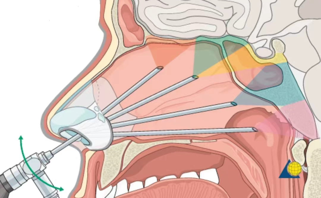 操作鼻窦镜时怎么摆【红旗分享】鼻内镜手术简介及术后注意事项_https://www.jmylbn.com_新闻资讯_第8张