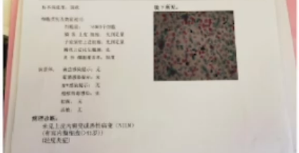 宫颈活检取样怎么取每周一课第14期精彩分享｜杨勇霞教授：绝经后宫颈筛查及异常结果管理相关问题探讨_https://www.jmylbn.com_新闻资讯_第2张