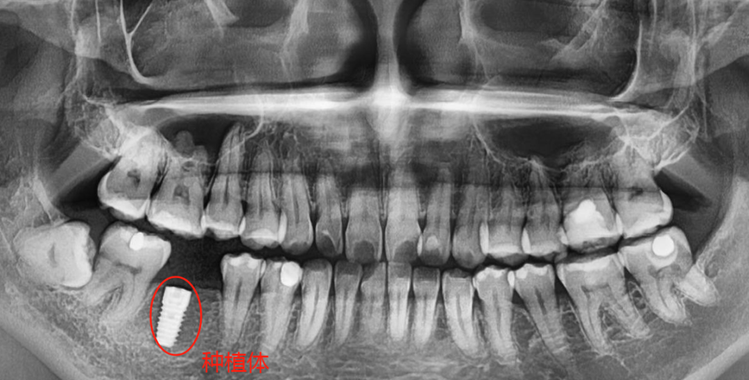 口腔ct怎么看拍了牙片怎么看？一分钟教会你快速看懂_https://www.jmylbn.com_新闻资讯_第13张