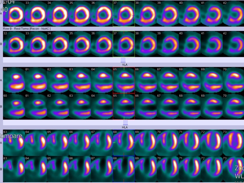 d-spect怎么检查绵绵“核”你说⑦胸痛检查的“核心利器”——核医学SPECT／CT心肌灌注显像_https://www.jmylbn.com_新闻资讯_第5张