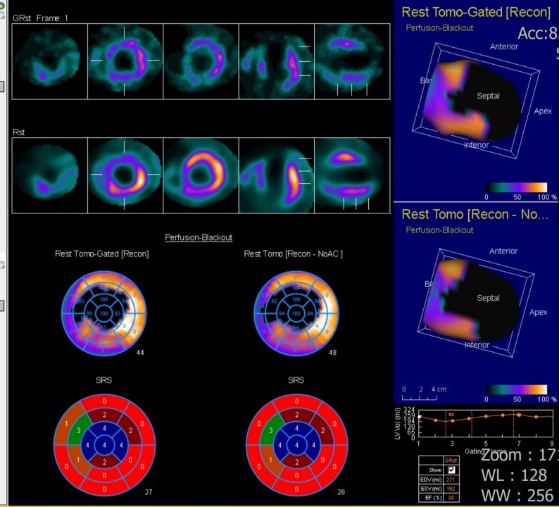 d-spect怎么检查绵绵“核”你说⑦胸痛检查的“核心利器”——核医学SPECT／CT心肌灌注显像_https://www.jmylbn.com_新闻资讯_第6张