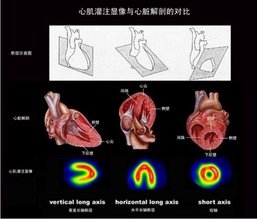 d-spect怎么检查绵绵“核”你说⑦胸痛检查的“核心利器”——核医学SPECT／CT心肌灌注显像_https://www.jmylbn.com_新闻资讯_第7张