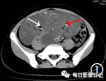 卵巢畸胎瘤中等大小是多大_卵巢里的畸胎瘤可以自己消失吗_卵巢畸胎瘤100个人中有几个