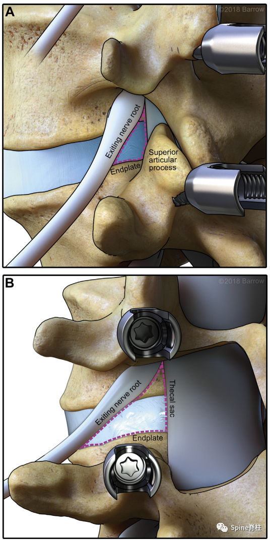 “安全三角”真的安全吗？——脊柱微创里的