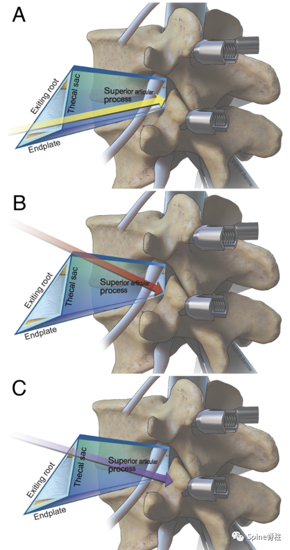 “安全三角”真的安全吗？——脊柱微创里的