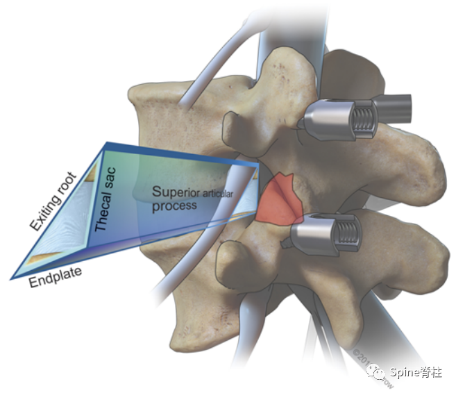 “安全三角”真的安全吗？——脊柱微创里的