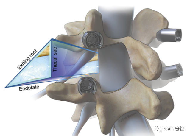 “安全三角”真的安全吗？——脊柱微创里的