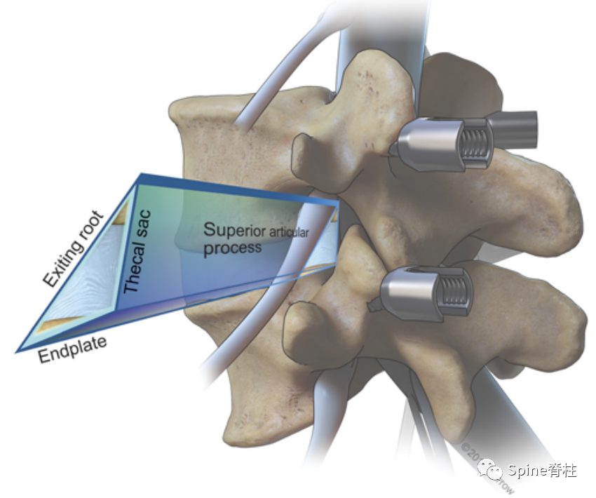 “安全三角”真的安全吗？——脊柱微创里的