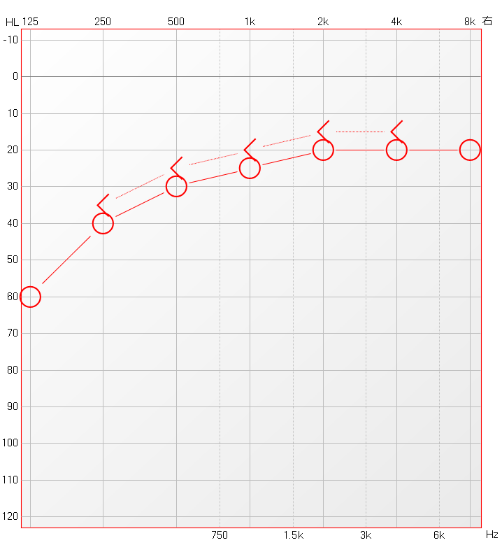 博闻 | 熬夜后耳鸣、听不清？警惕突发性耳聋！(图10)