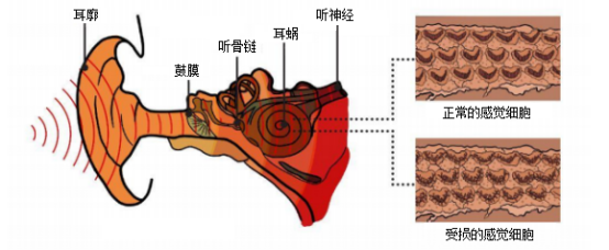 博闻 | 熬夜后耳鸣、听不清？警惕突发性耳聋！(图9)