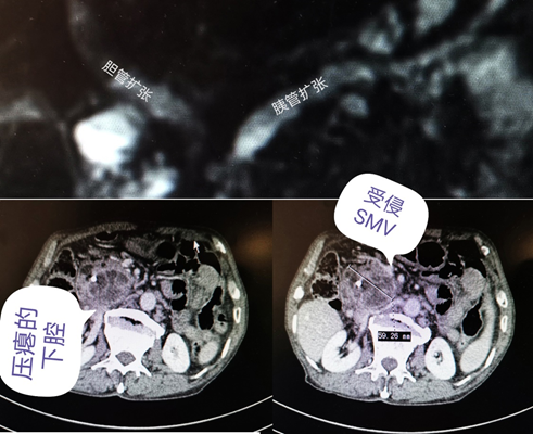 “胰”路有你，虚惊一场的“胰腺癌”
