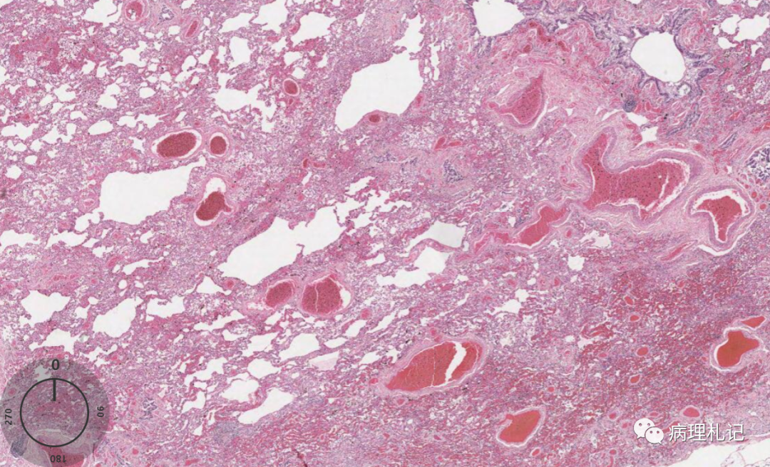 肺部一些异常的病理切片