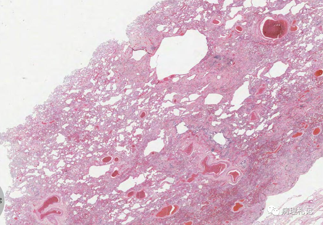 肺部一些异常的病理切片