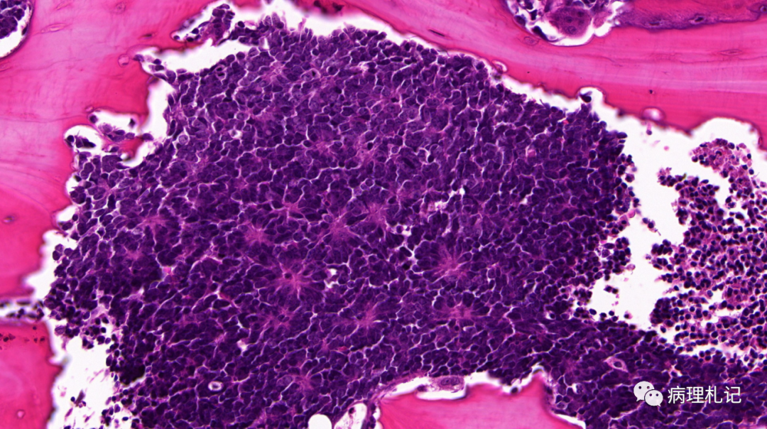 弥漫性神经纤维瘤中惊叹wagnermeissner小体