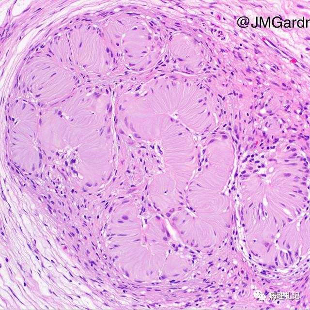 弥漫性神经纤维瘤中惊叹wagnermeissner小体