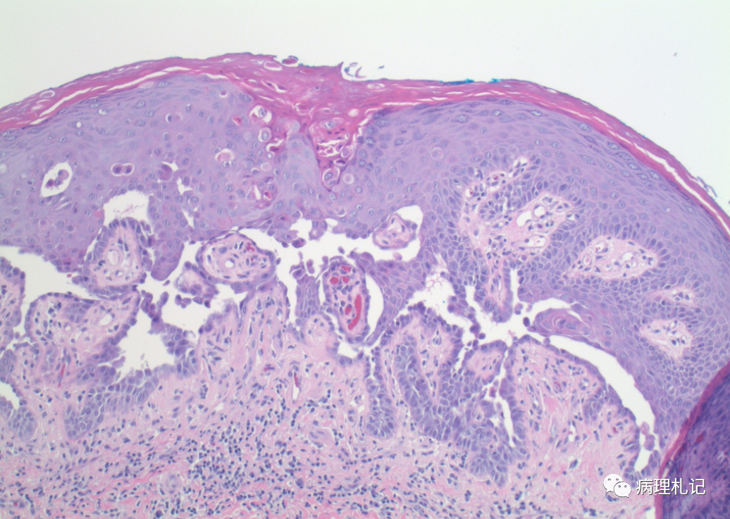 丘疹性棘層鬆解性角化不良papular acantholytic dys