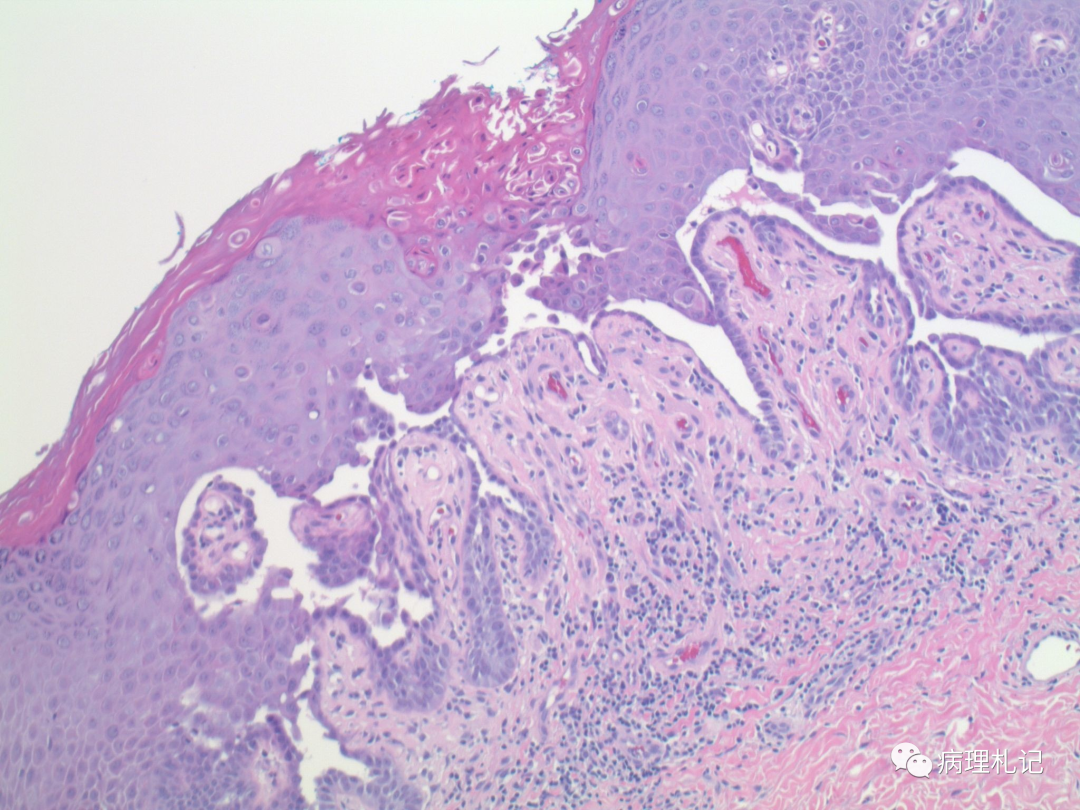 丘疹性棘層鬆解性角化不良papular acantholytic dys