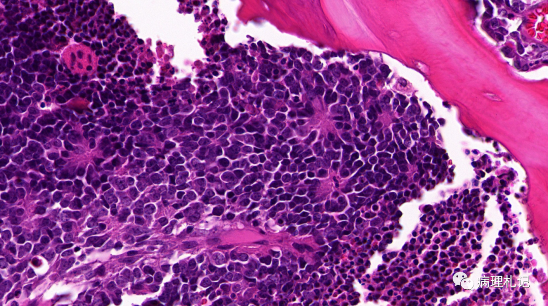 弥漫性神经纤维瘤中惊叹wagnermeissner小体