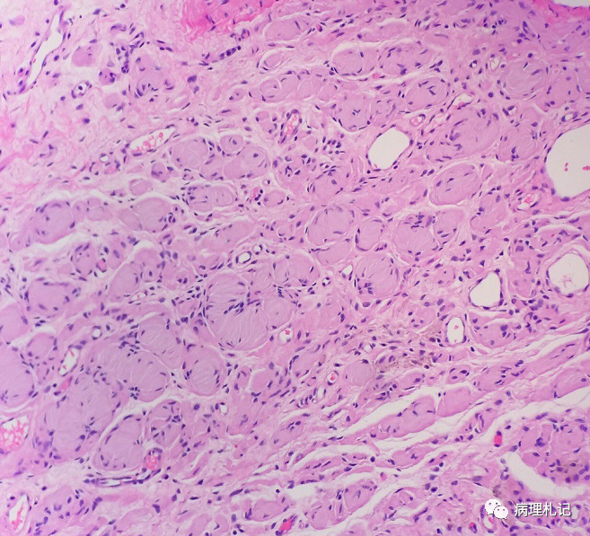 弥漫性神经纤维瘤中惊叹wagnermeissner小体