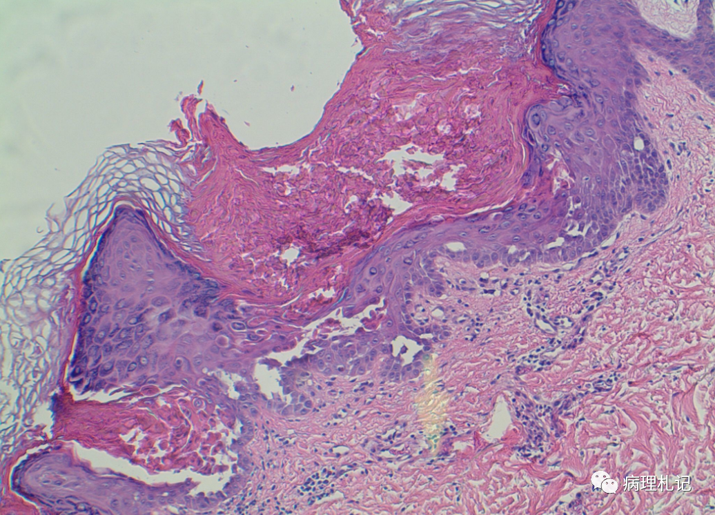 弥漫性神经纤维瘤中惊叹wagnermeissner小体
