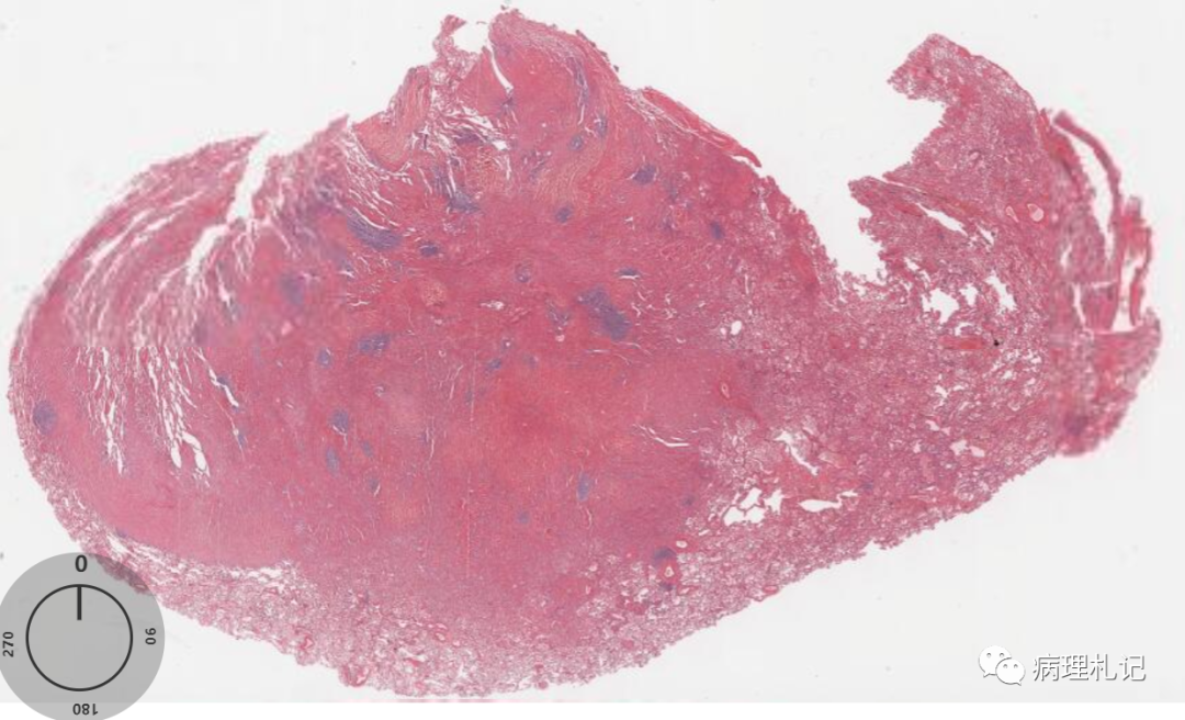 肺部一些异常的病理切片