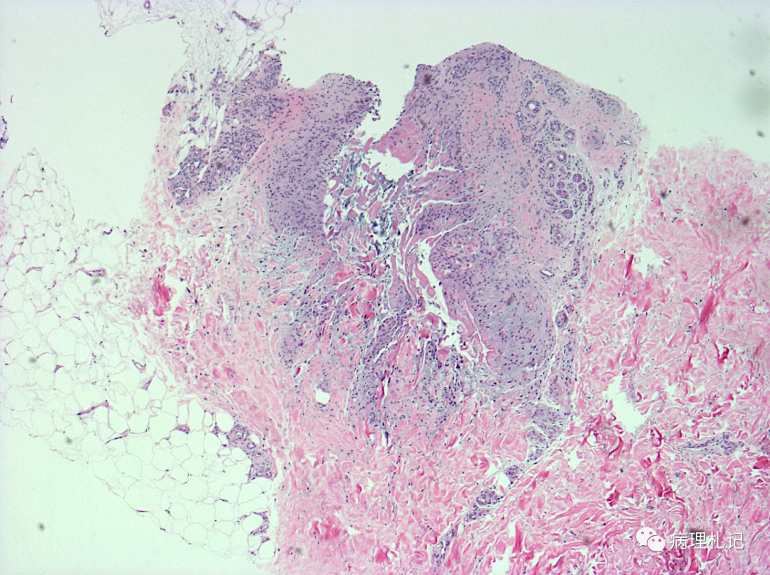 瘢痕组织镜下图片