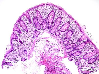 一起学习病理视界里的一例肥大细胞增多症