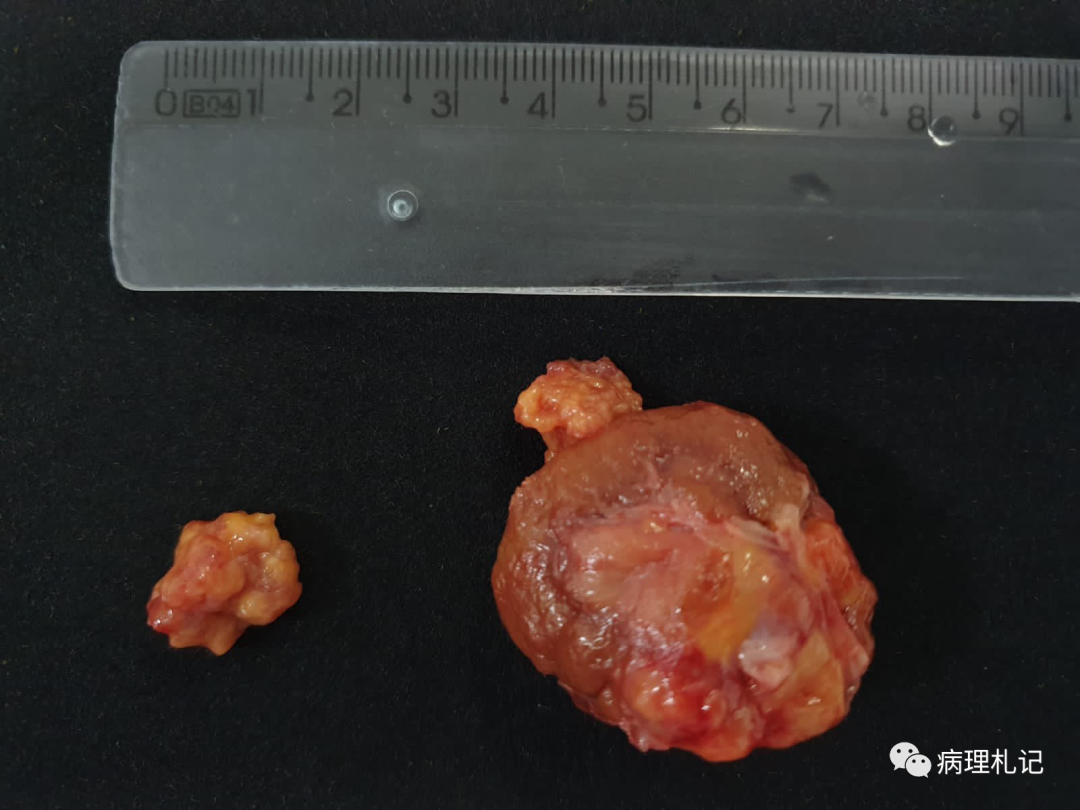 一例罕见的cmml和新发滤泡性淋巴瘤共存于同一淋巴结_医学界-助力医生