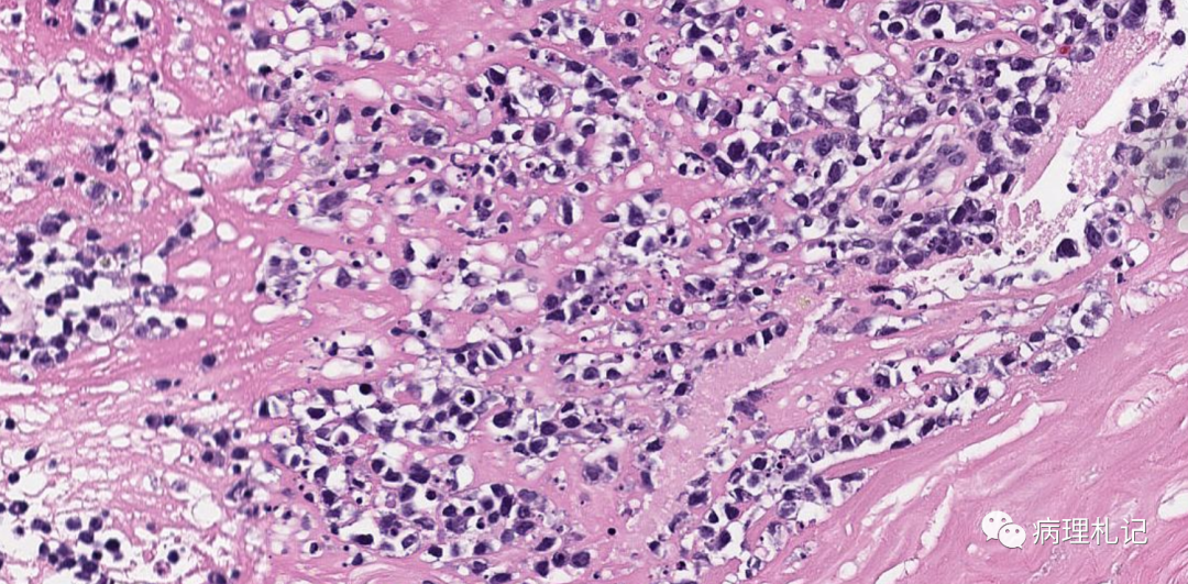 纤维蛋白相关的弥漫性大b细胞淋巴瘤的镜下观