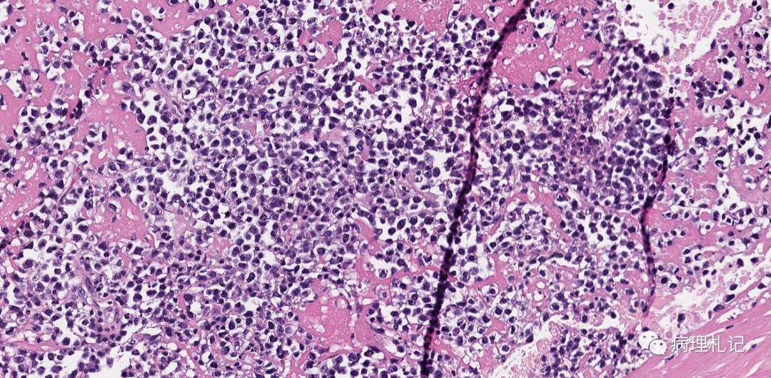 纤维蛋白相关的弥漫性大b细胞淋巴瘤的镜下观