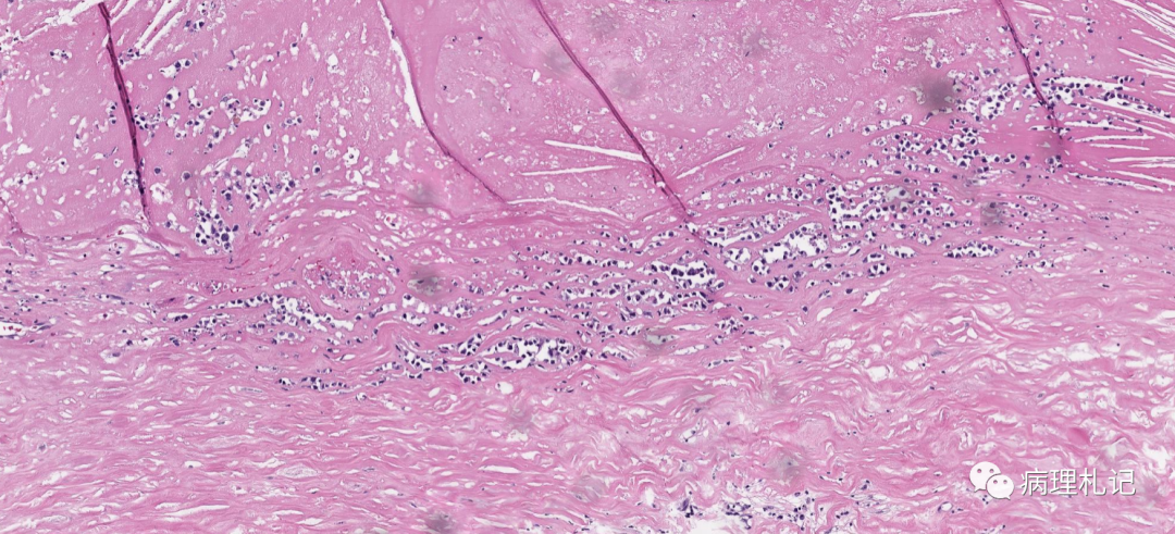 纤维蛋白相关的弥漫性大b细胞淋巴瘤的镜下观