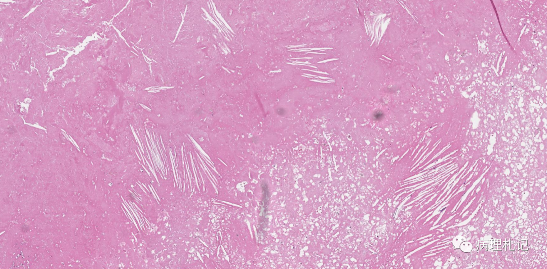 纤维蛋白相关的弥漫性大b细胞淋巴瘤的镜下观