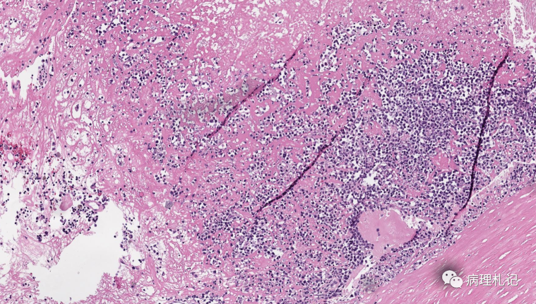 纤维蛋白相关的弥漫性大b细胞淋巴瘤的镜下观