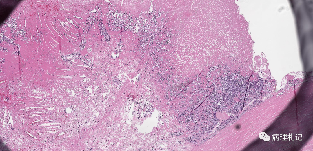 纤维蛋白相关的弥漫性大b细胞淋巴瘤的镜下观